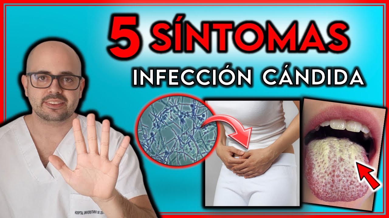como saber si tengo hongos en la boca