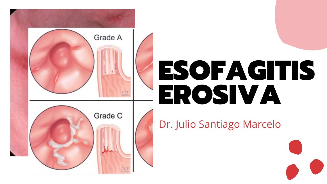 esofagitis peptica grado b de los angeles