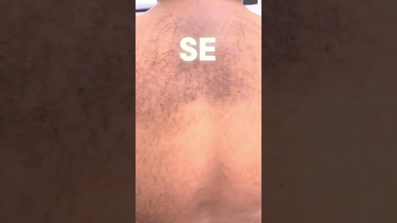 manchas en la espalda por estrés