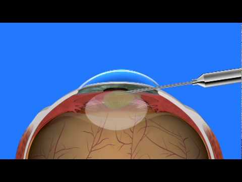 operacion de cataratas en personas mayores