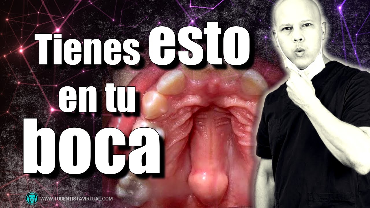 bulto en el cielo de la boca con dolor