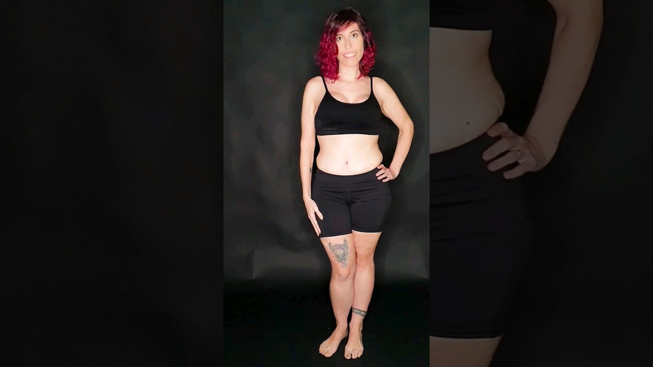 bypass gastrico antes y despues piel