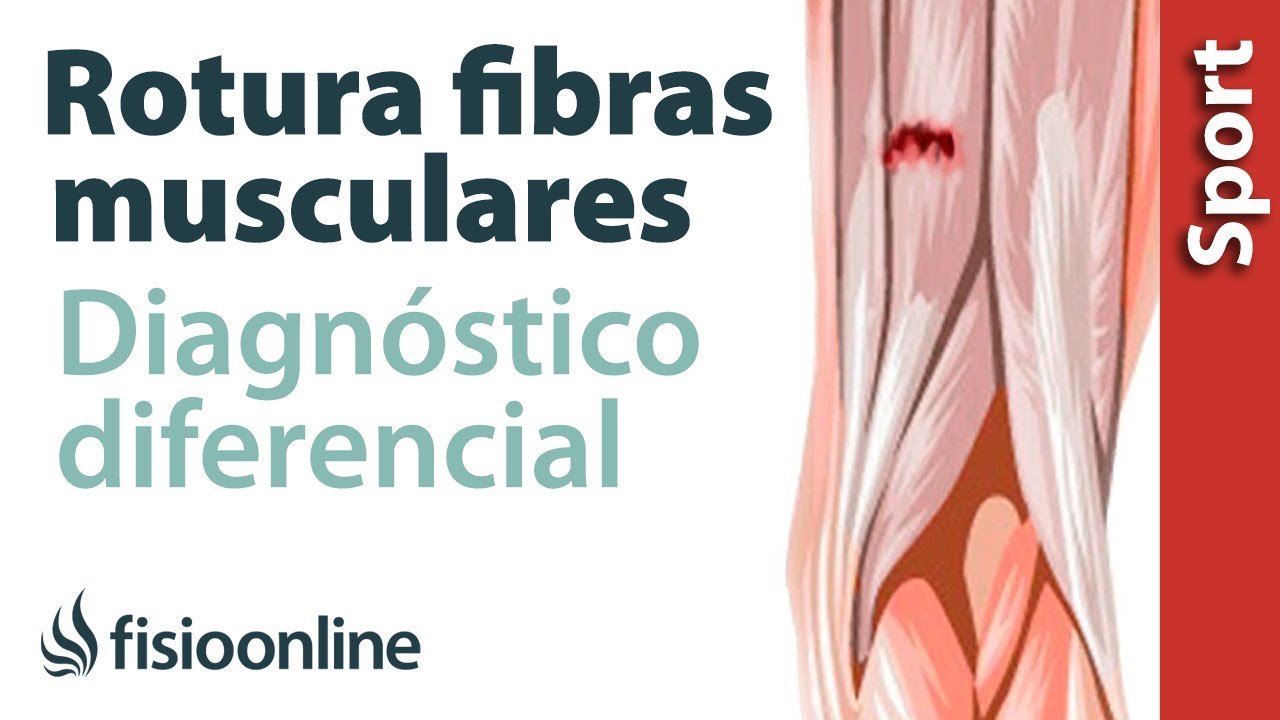 como saber si tienes rotura de fibras en el isquiotibial