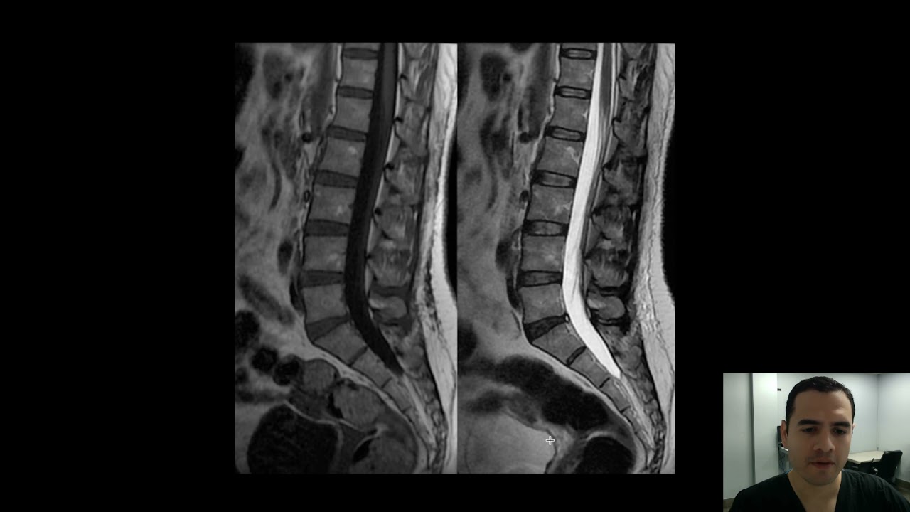 cortes sagitales y axiales en t1 y t2