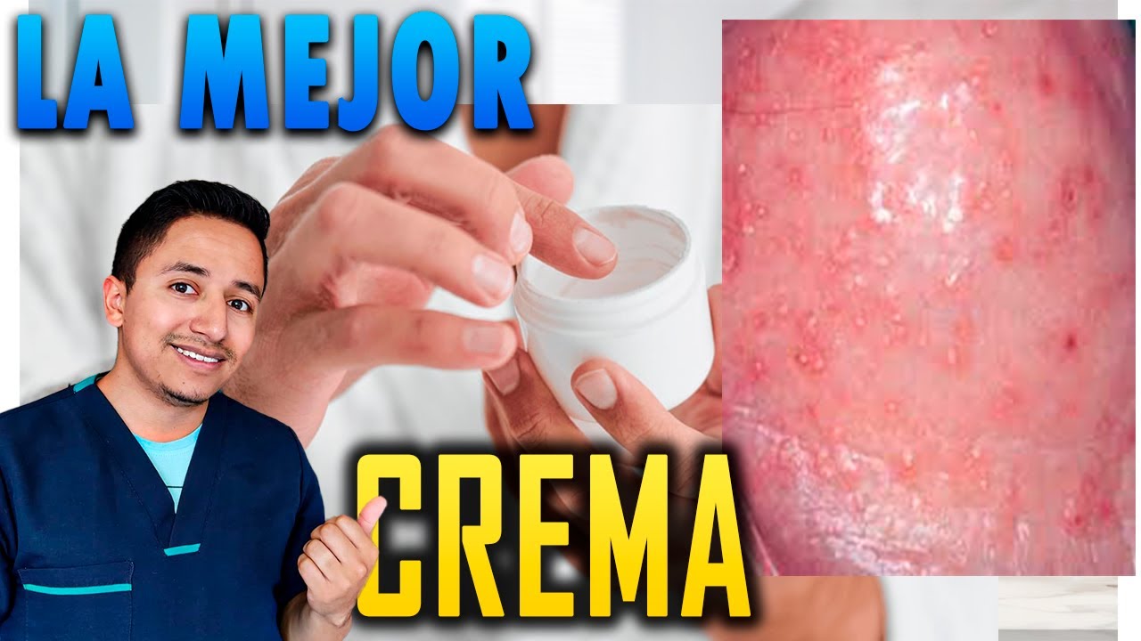 crema para la irritacion del glande