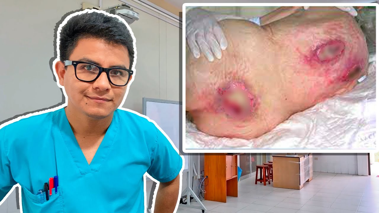curación de úlceras por presión enfermería