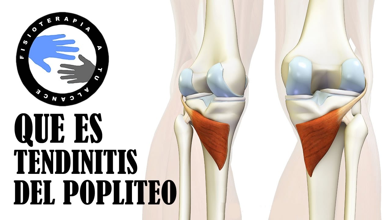 dolor atras de la rodilla al doblarla