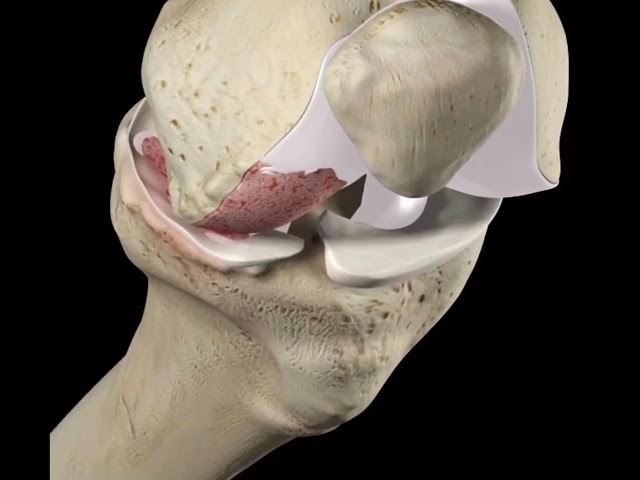 edema oseo en la meseta tibial