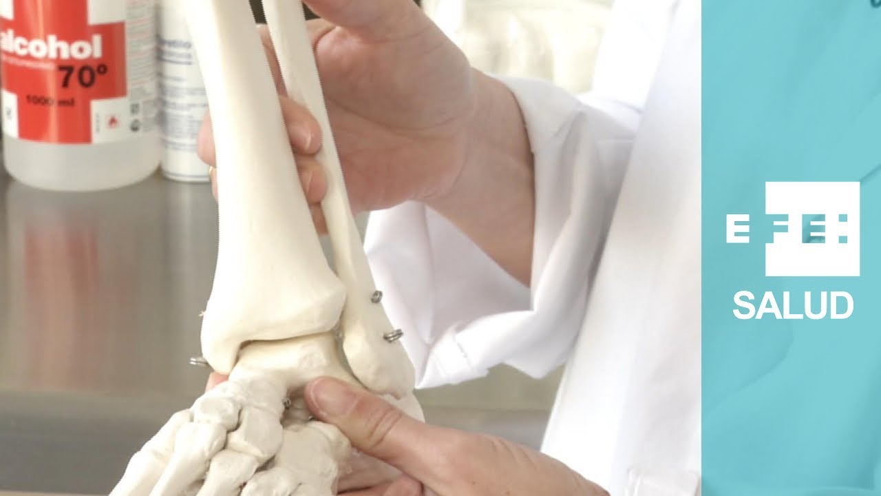 fractura de perone tiempo de yeso