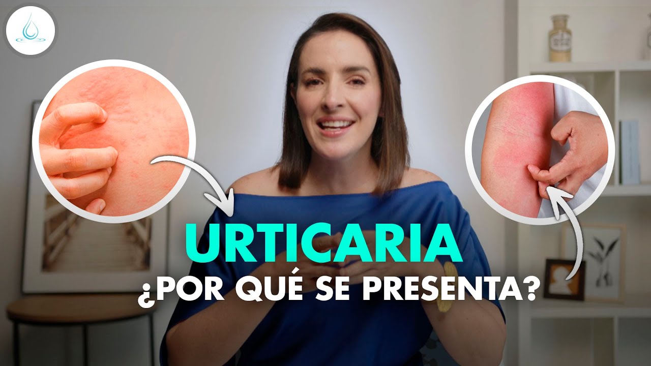 la mejor crema para la urticaria
