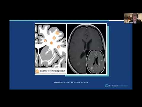lesiones hiperintensas en t2 esclerosis múltiple