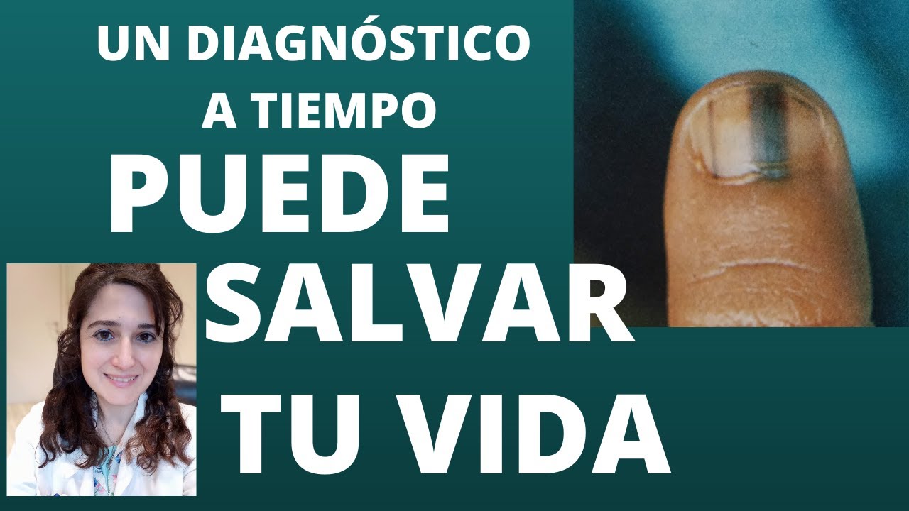 mancha marron uña dedo gordo pie