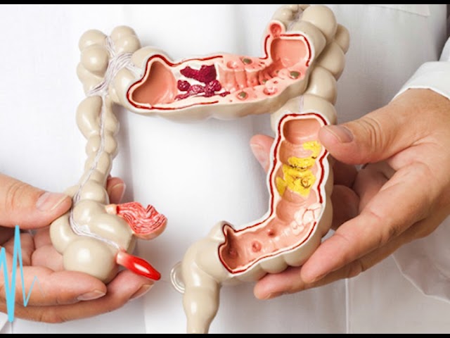 manchar por el ano después de colostomía