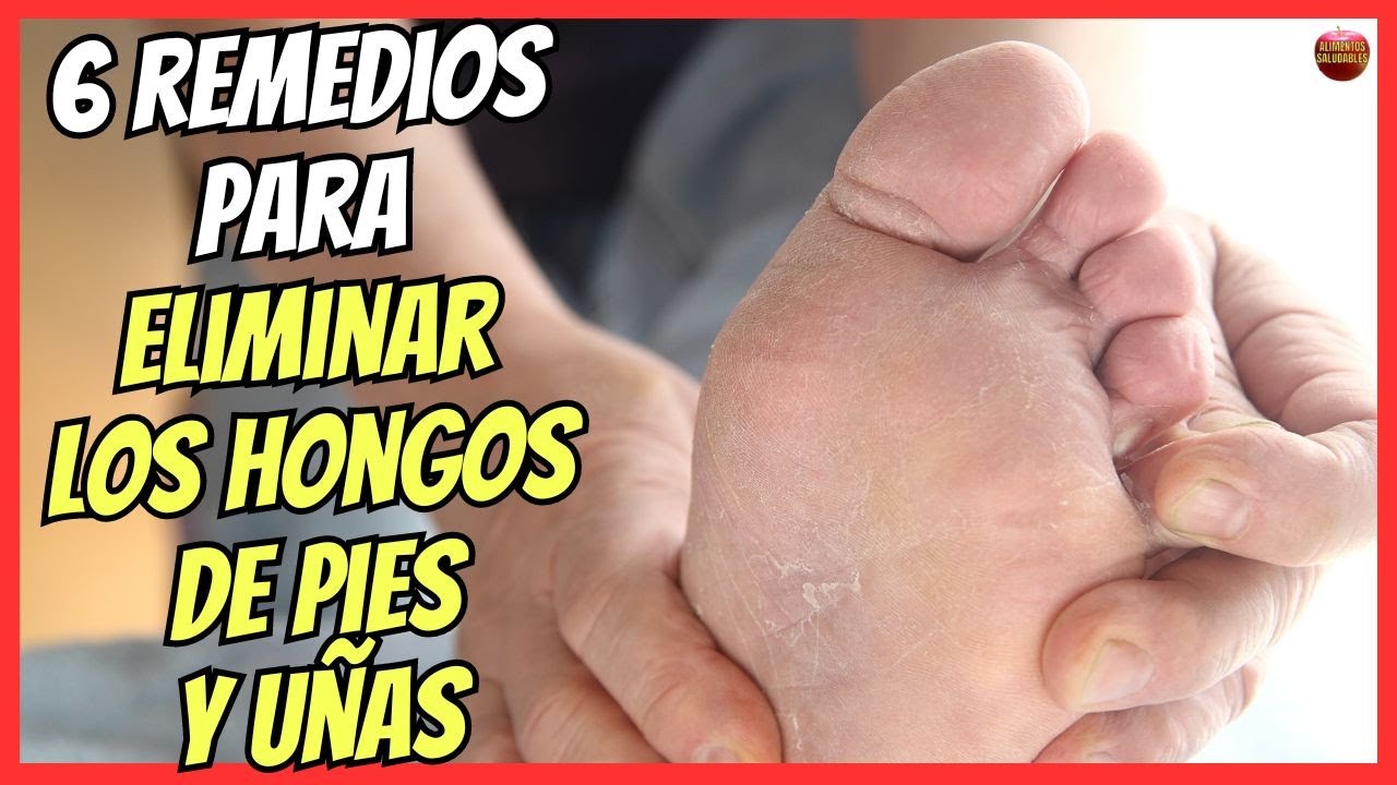 mejor crema para hongos en los pies