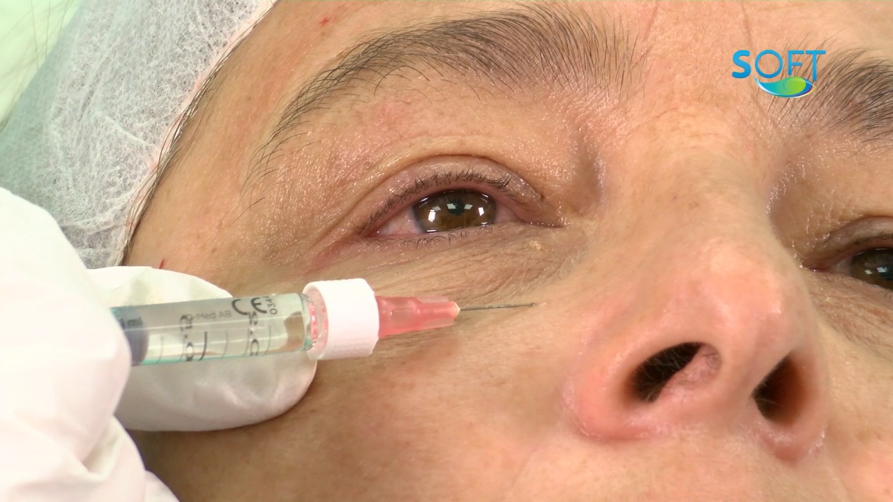 mesoterapia facial con vitaminas antes y después
