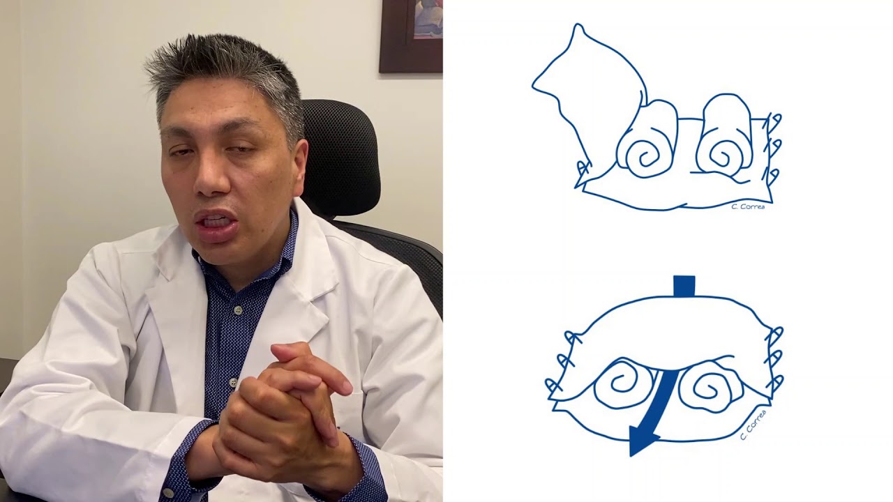 operacion de muñeca tiempo de recuperacion