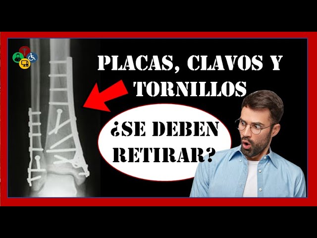 operacion de tibia y perone con placa y tornillos
