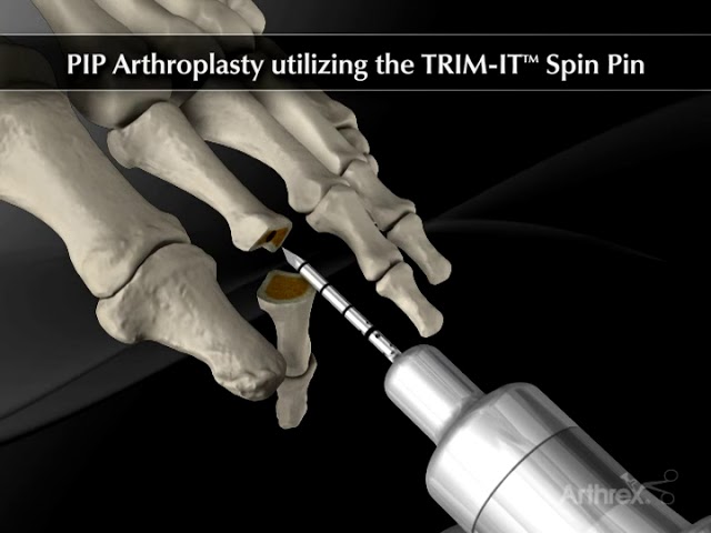 operacion dedos en garra antes y despues