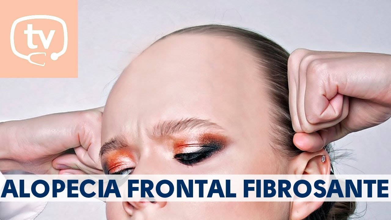 peinados para mujeres con alopecia frontal