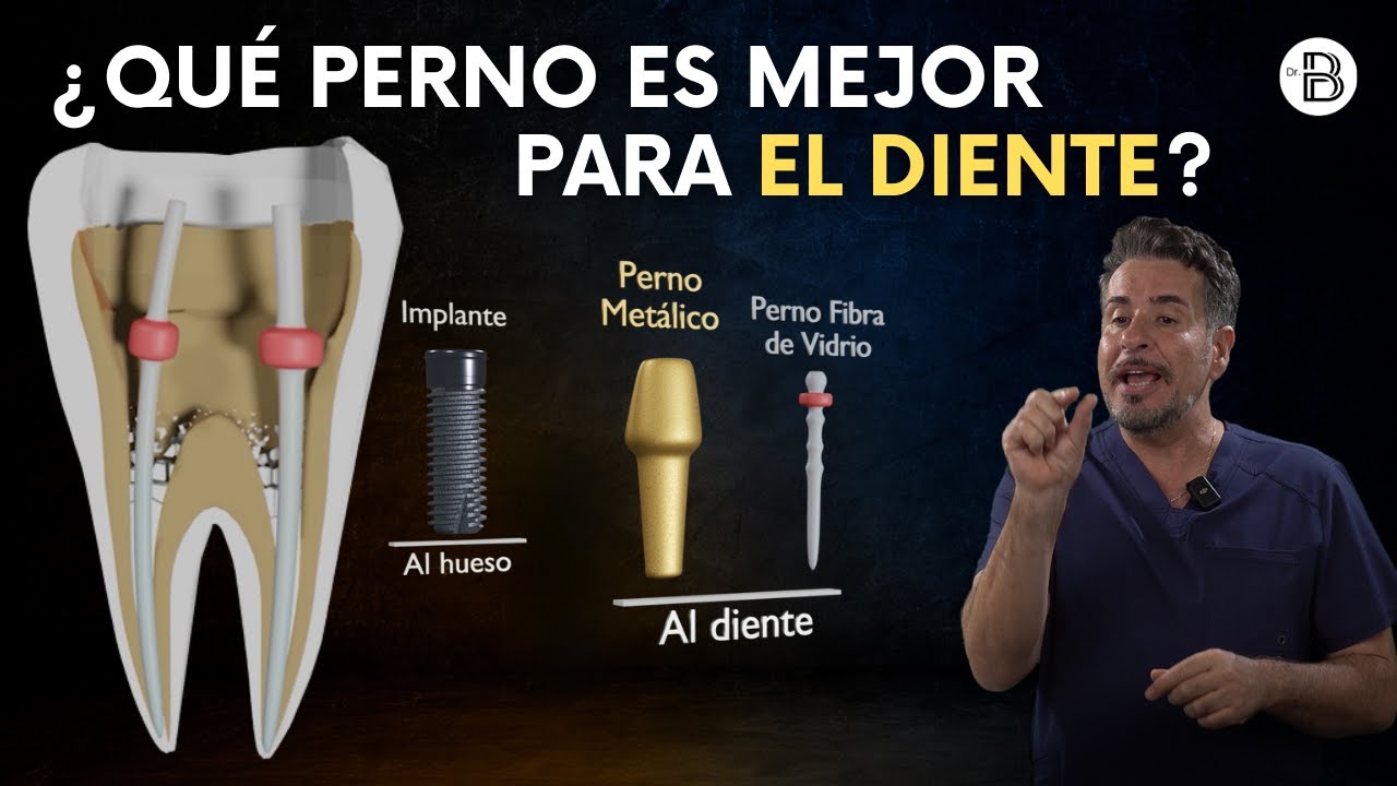 pernos dentales de fibra de vidrio