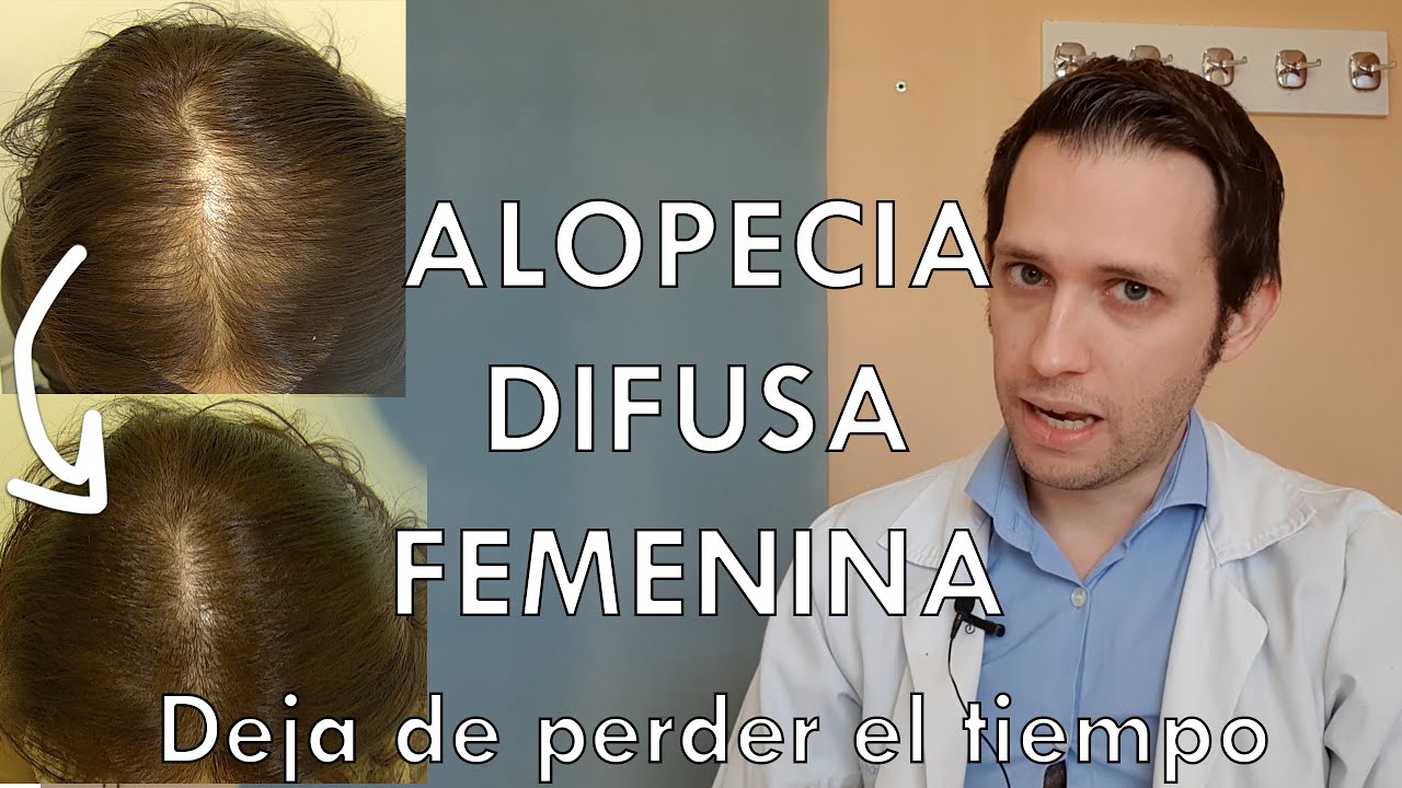 poco pelo en la coronilla mujer