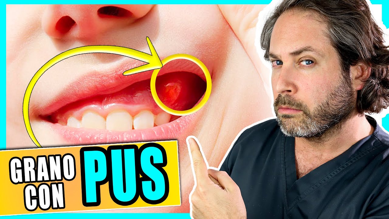 pus en la encía sin dolor