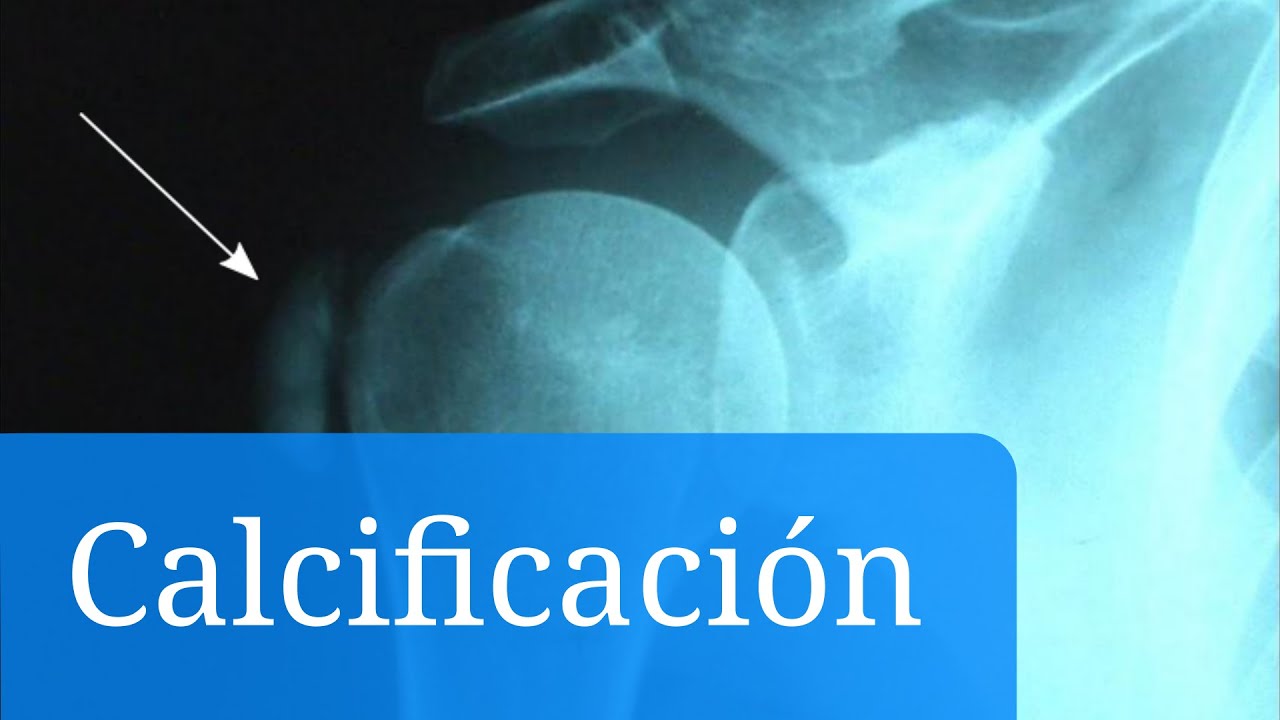 que es calcificación en los huesos