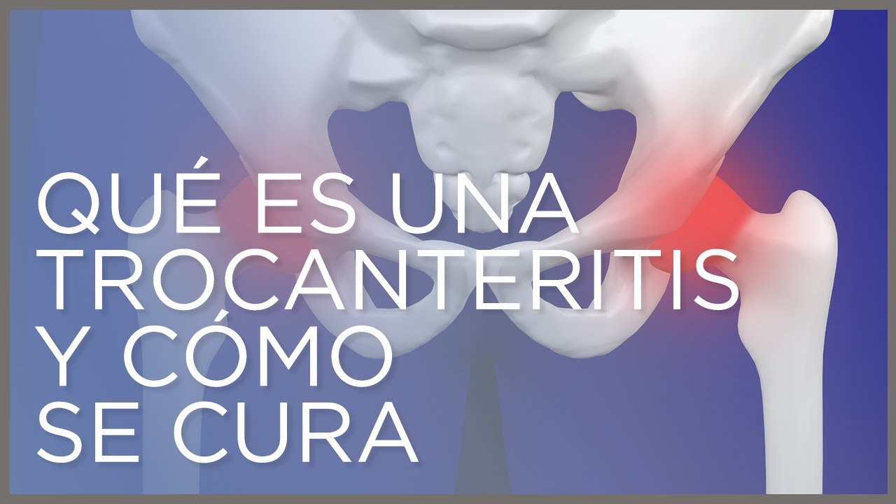 que es la trocanteritis de cadera