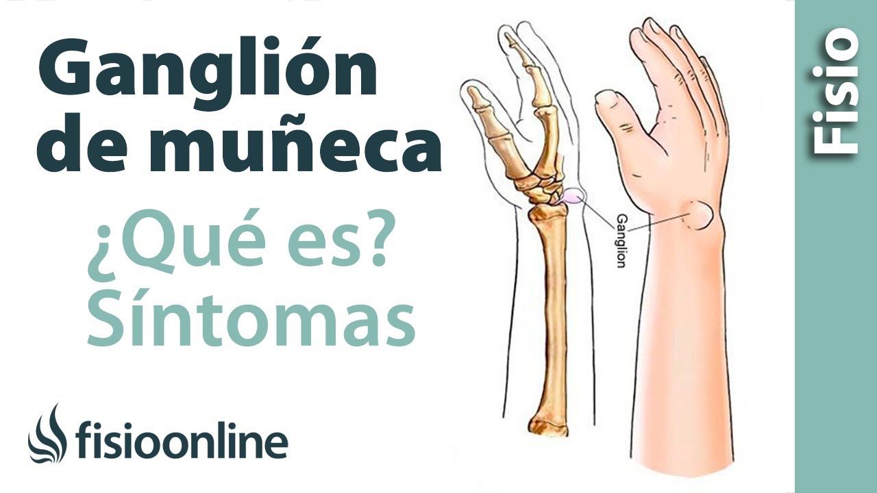 que es tener la muñeca abierta