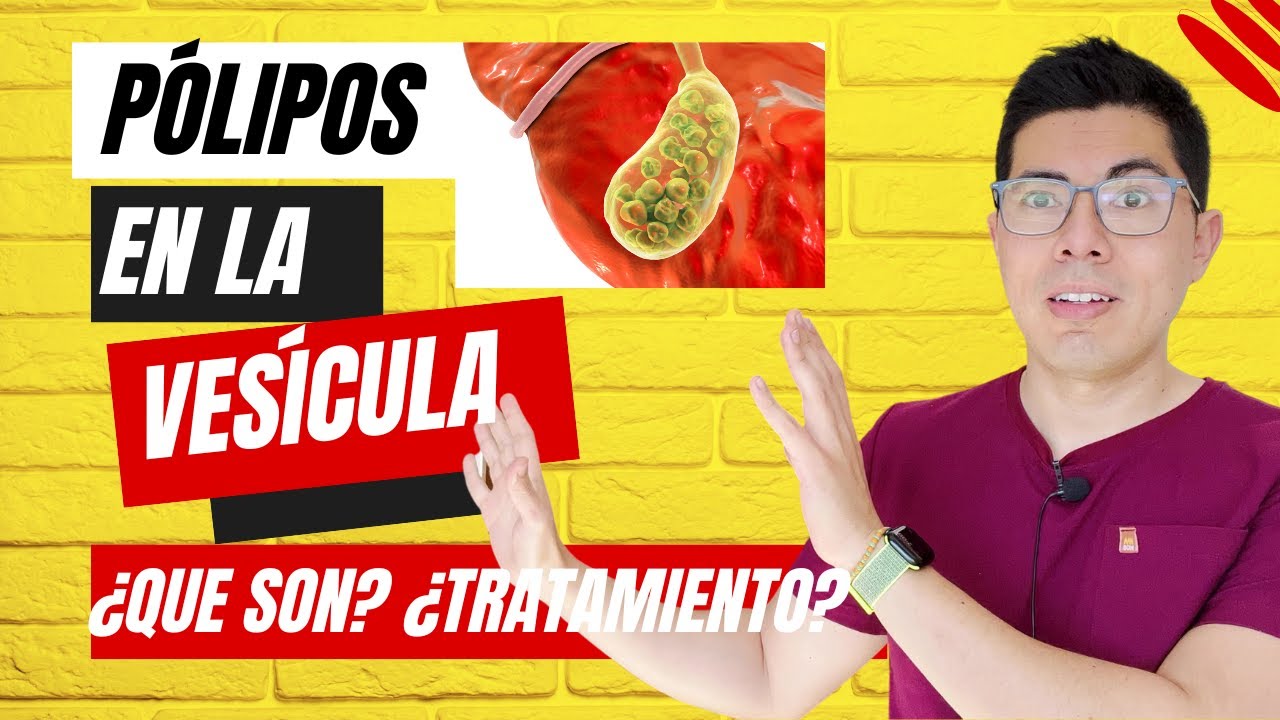 que es un polipo en la vesicula
