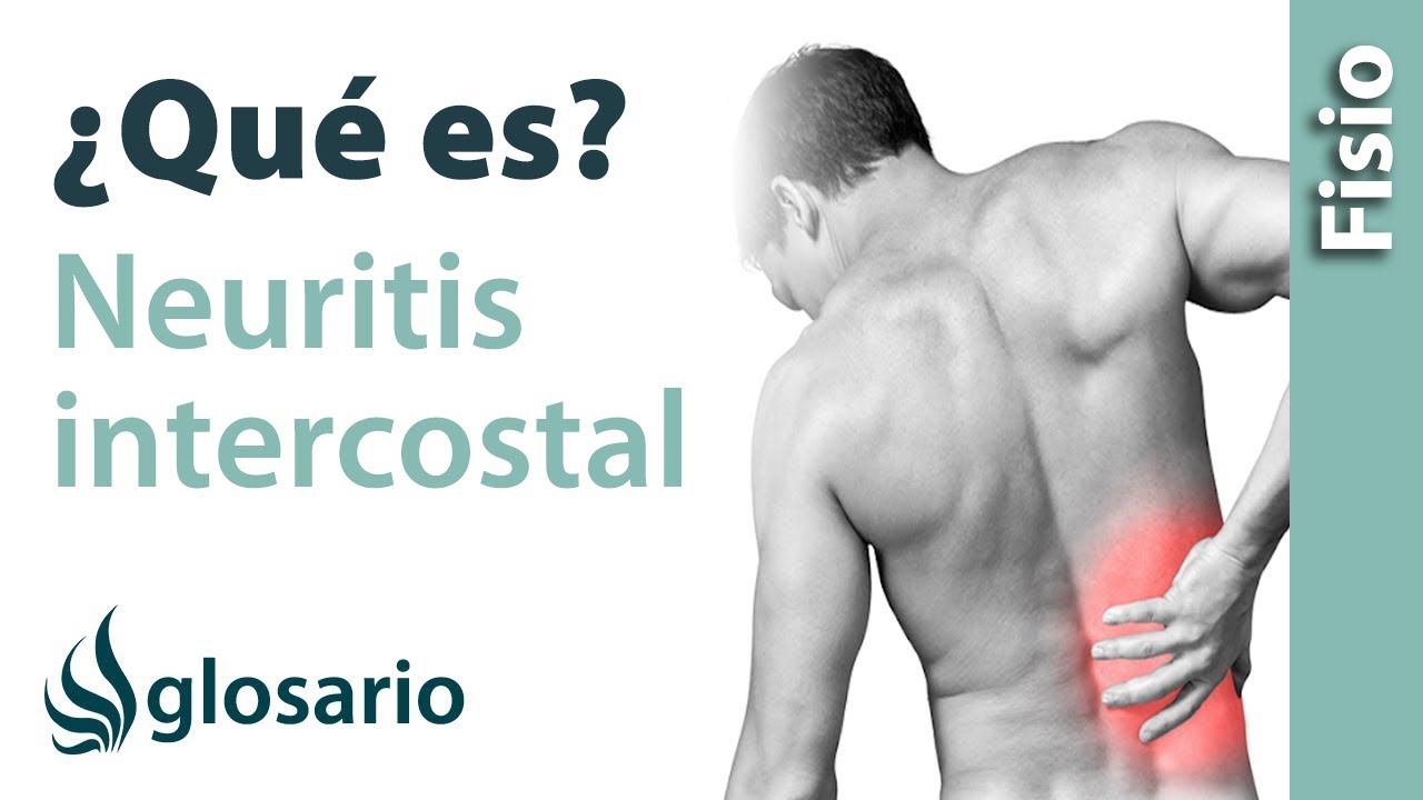 que médico trata la neuritis intercostal