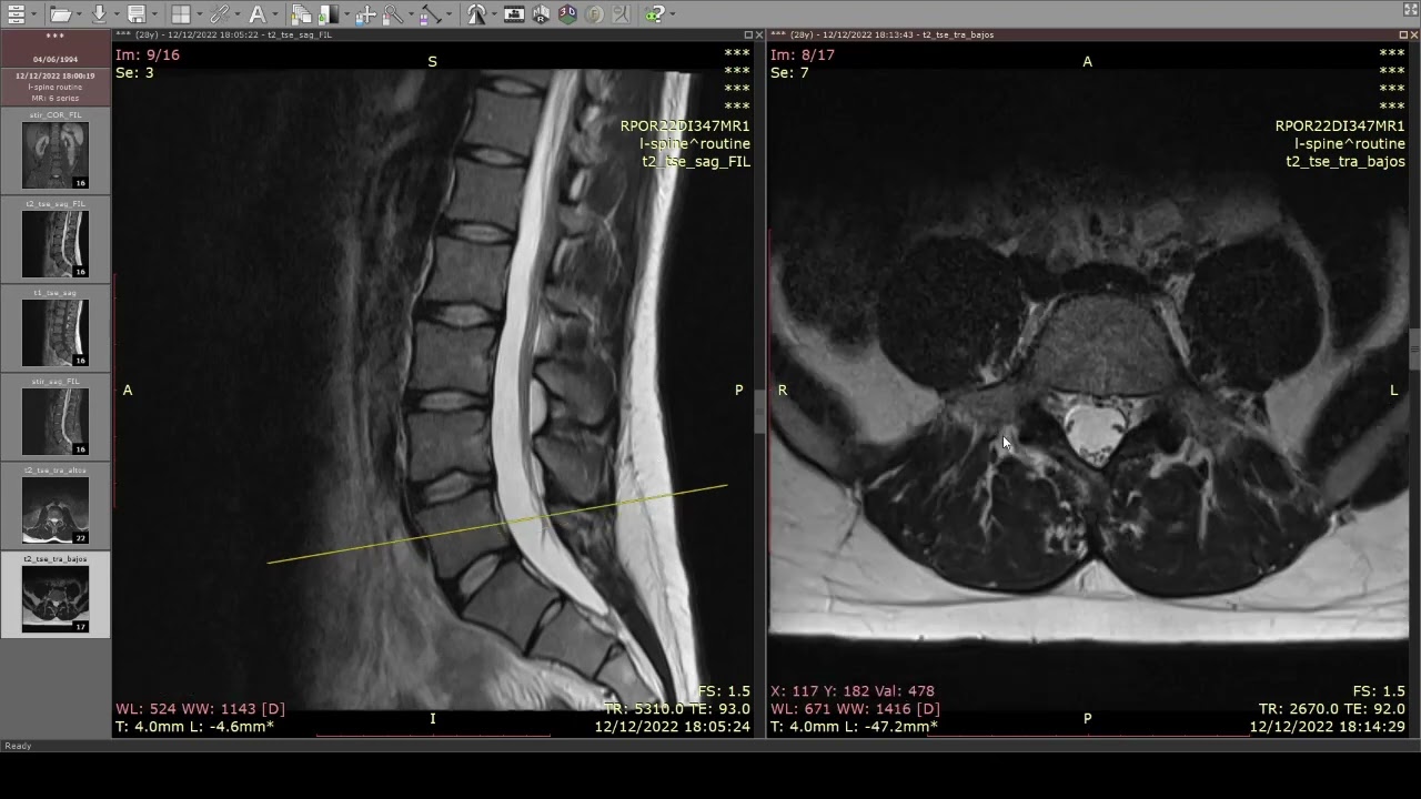 que se ve en un tac lumbar