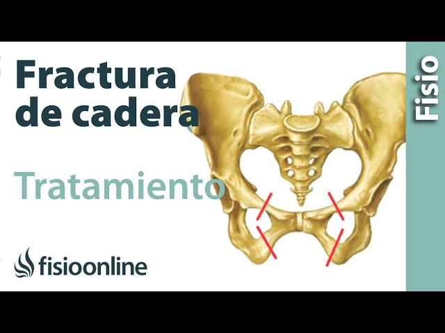 rotura de pelvis tiempo de recuperación