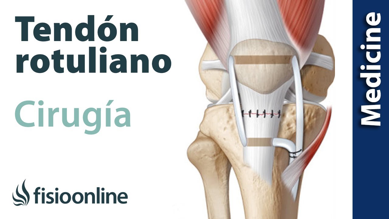 rotura del tendón rotuliano tiempo de recuperación