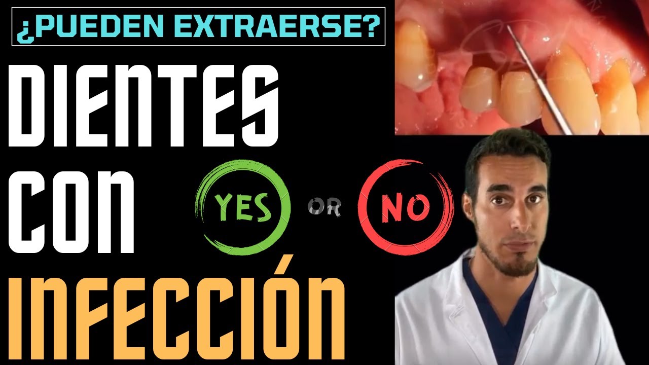 se puede sacar una muela con infeccion