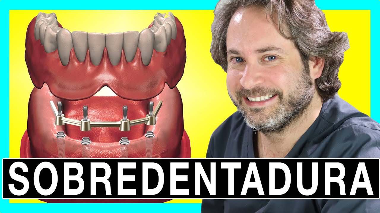 sobredentadura con barra sobre 4 implantes