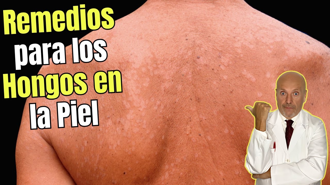 tratamiento para el hongo en la piel
