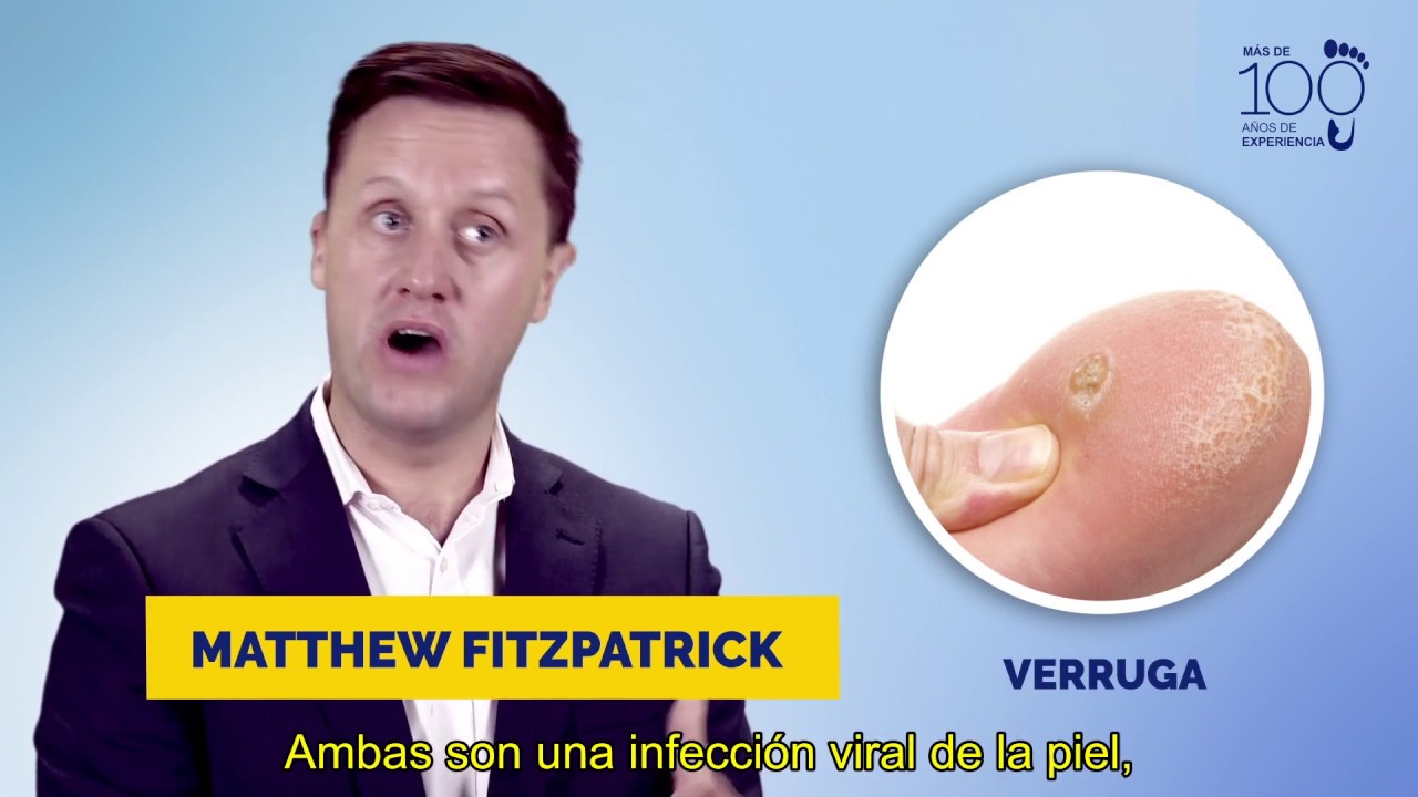 verruga en el dedo del pie