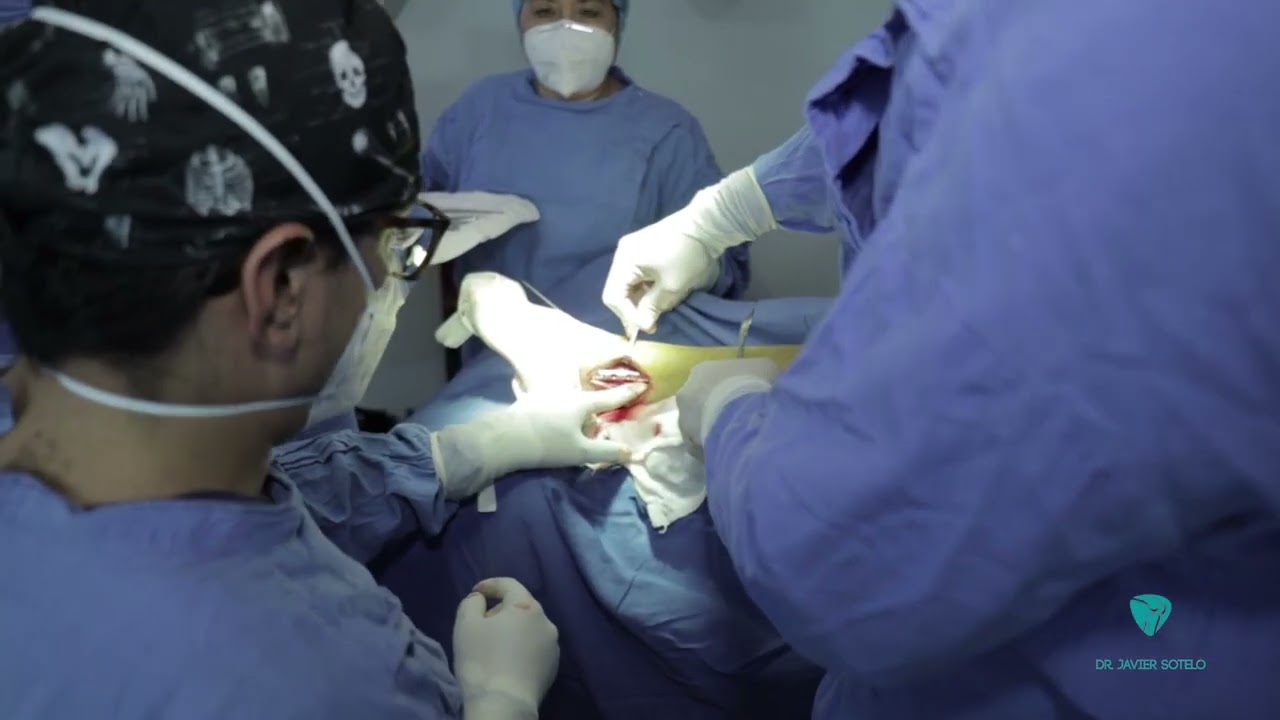 caminar despues de fractura de tibia y perone