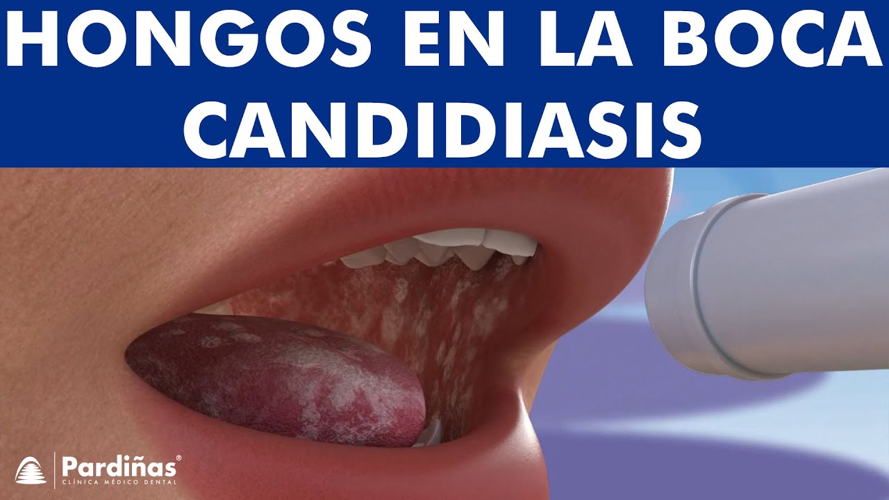 como curar hongos en la boca
