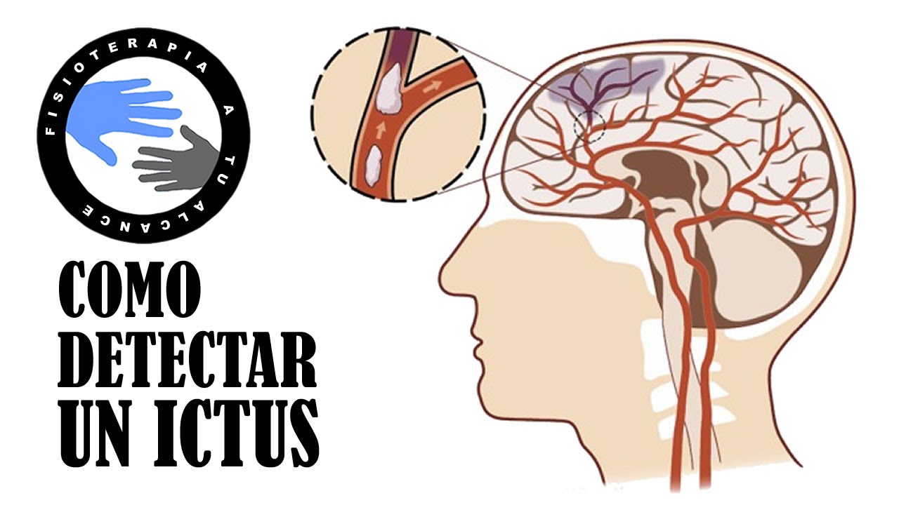 como detectar un ictus en un minuto