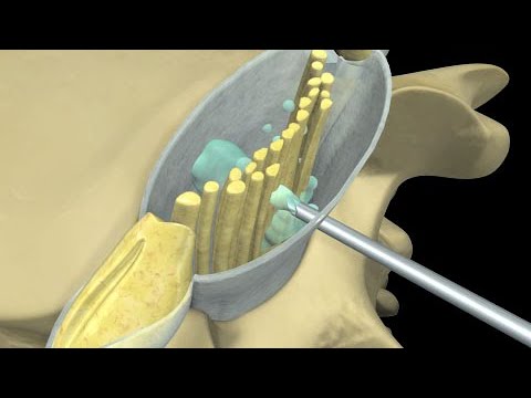 como es la aguja de la epidural