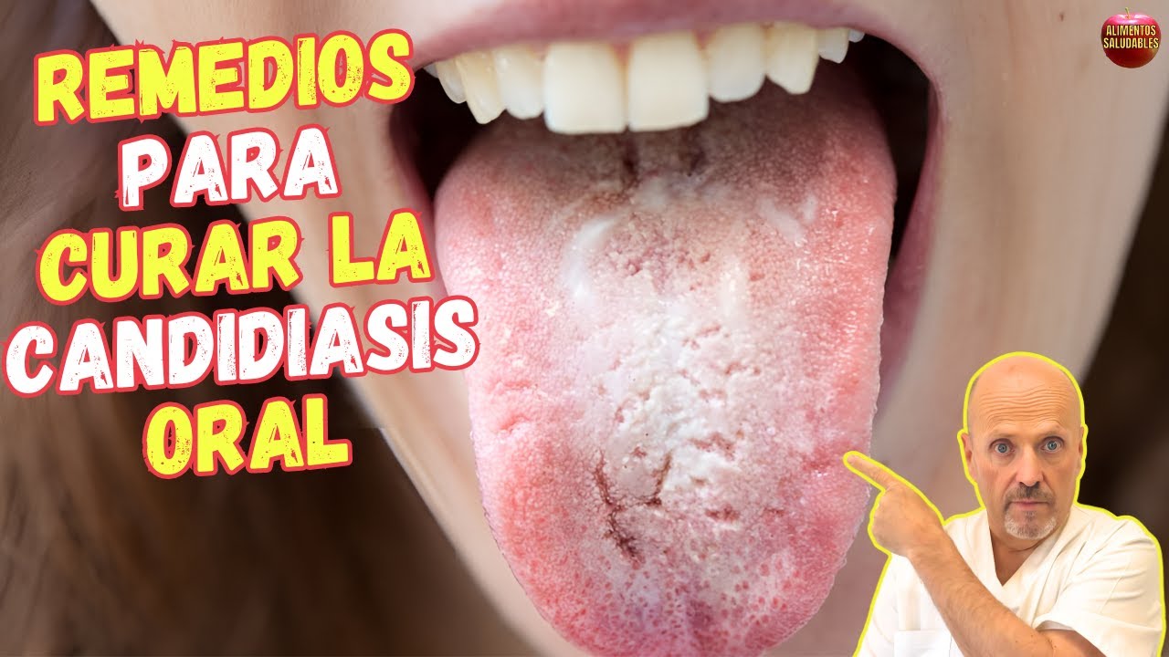 como quitar la candidiasis de la boca