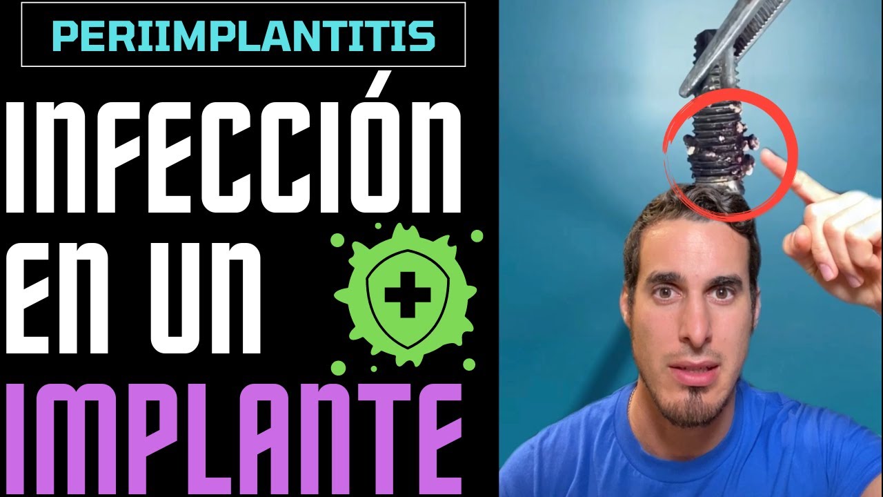 como saber si hay infeccion en un implante dental