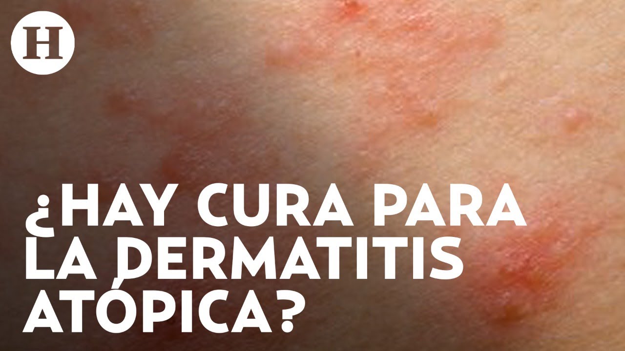como saber si tengo piel atopica