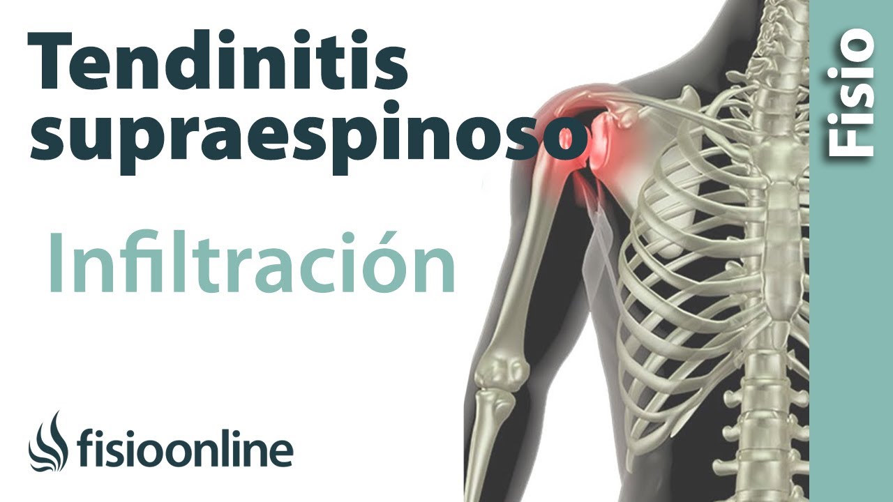 cuantas infiltraciones se pueden poner en el hombro