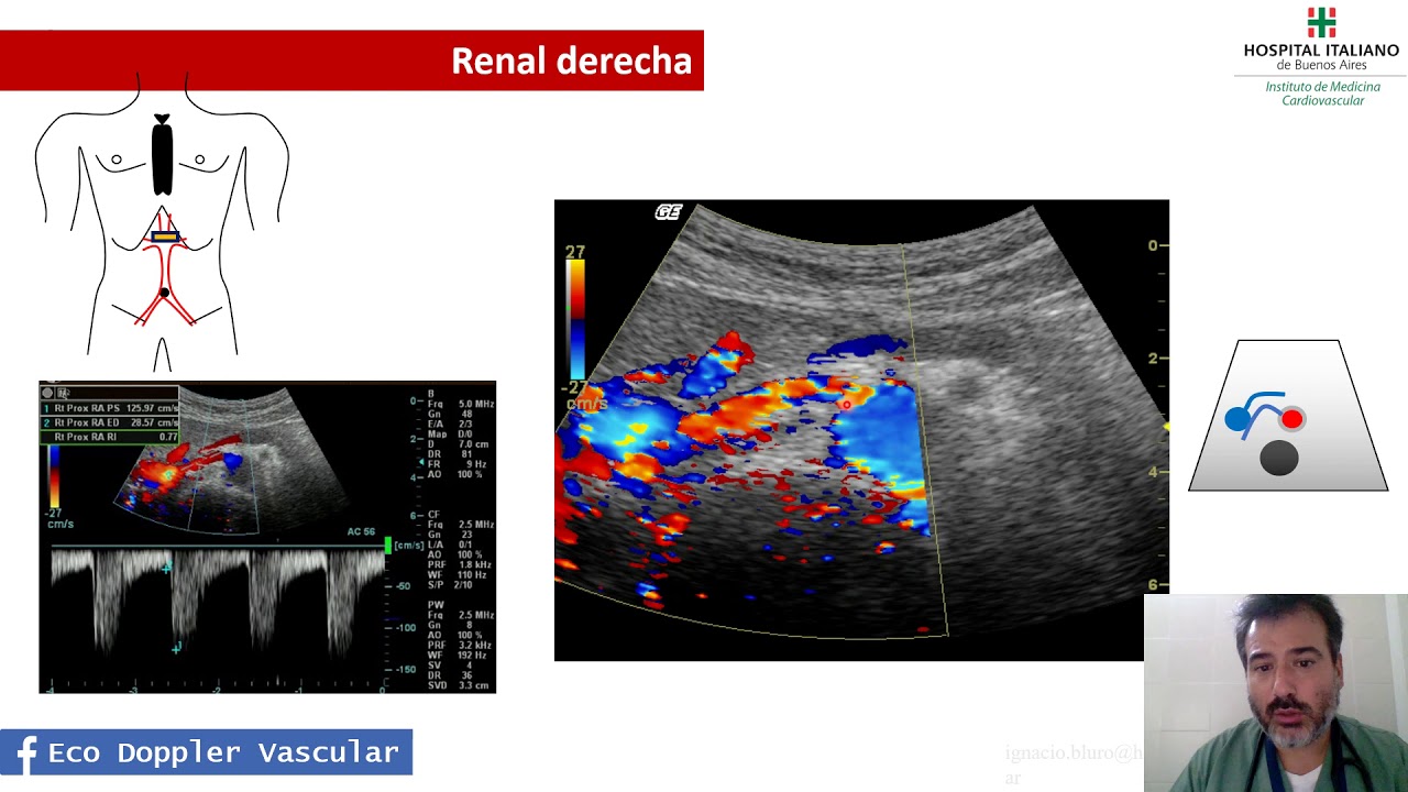 eco doppler renal para que sirve