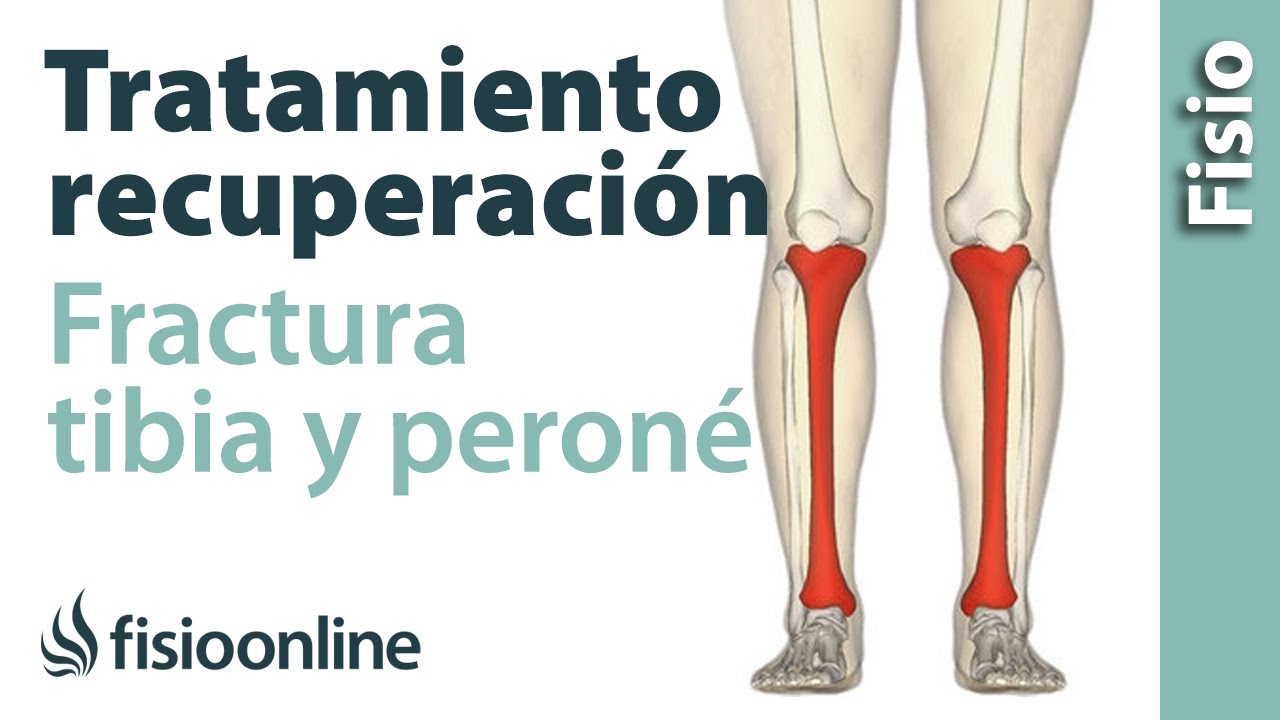 fractura de peroné distal tiempo de recuperación