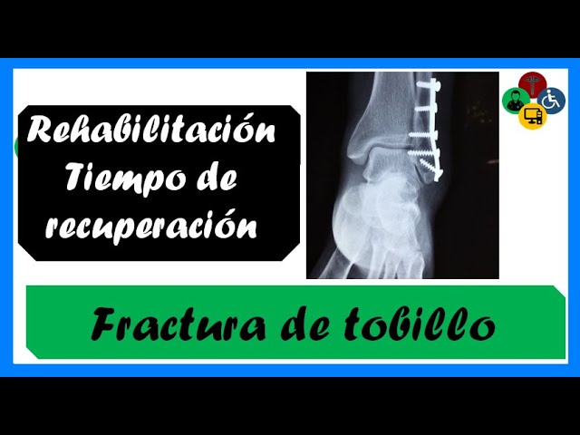 fractura de tobillo tiempo de recuperación