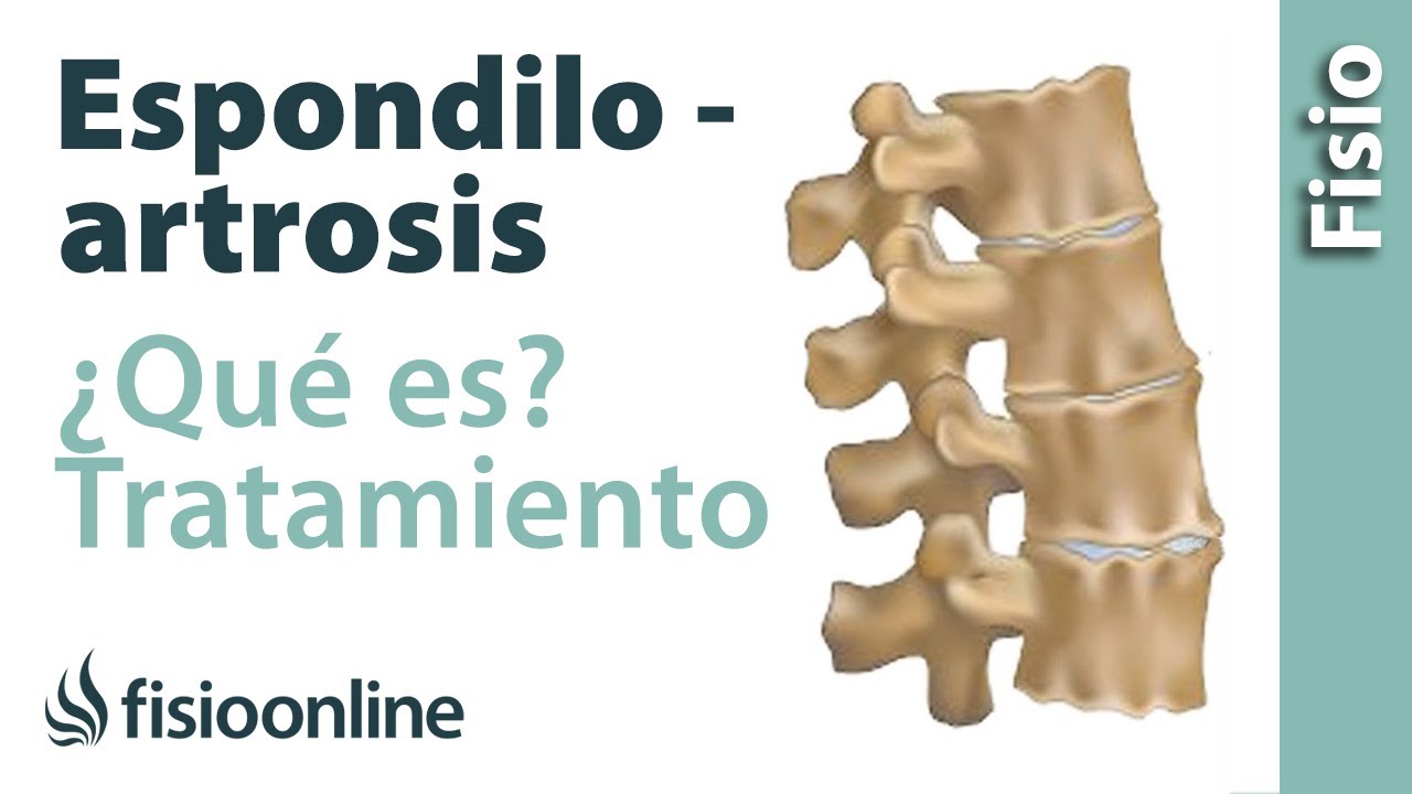 grado de discapacidad por espondiloartrosis lumbar